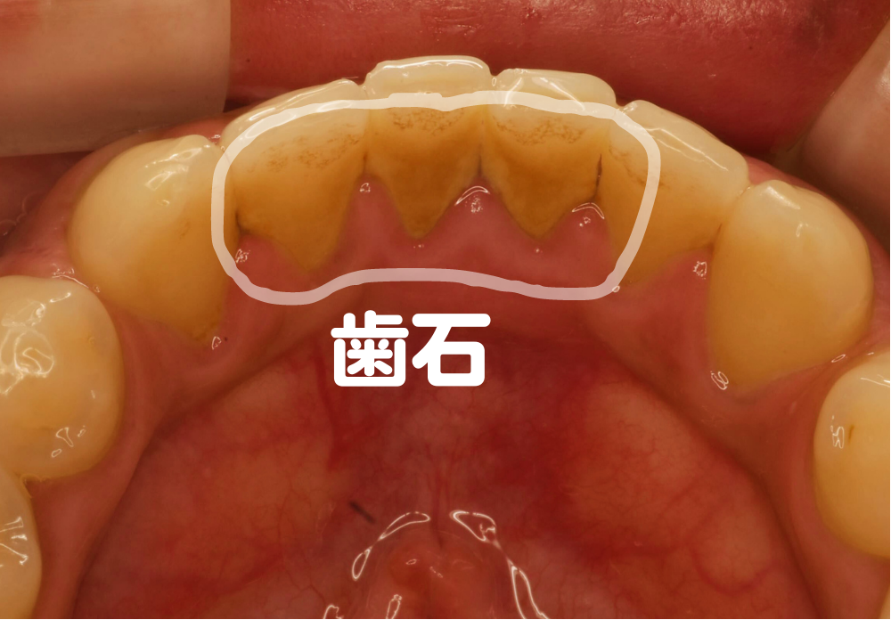 プロに歯石を除去してもらいましょう