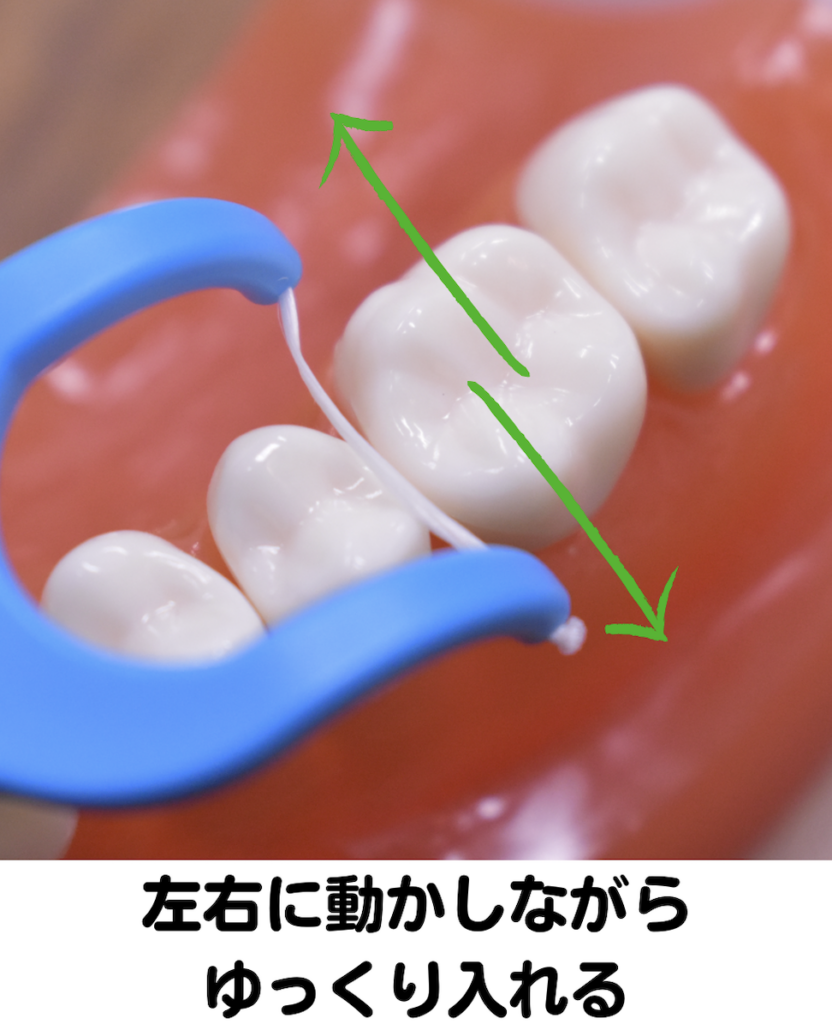 歯科医院　フロス　予防