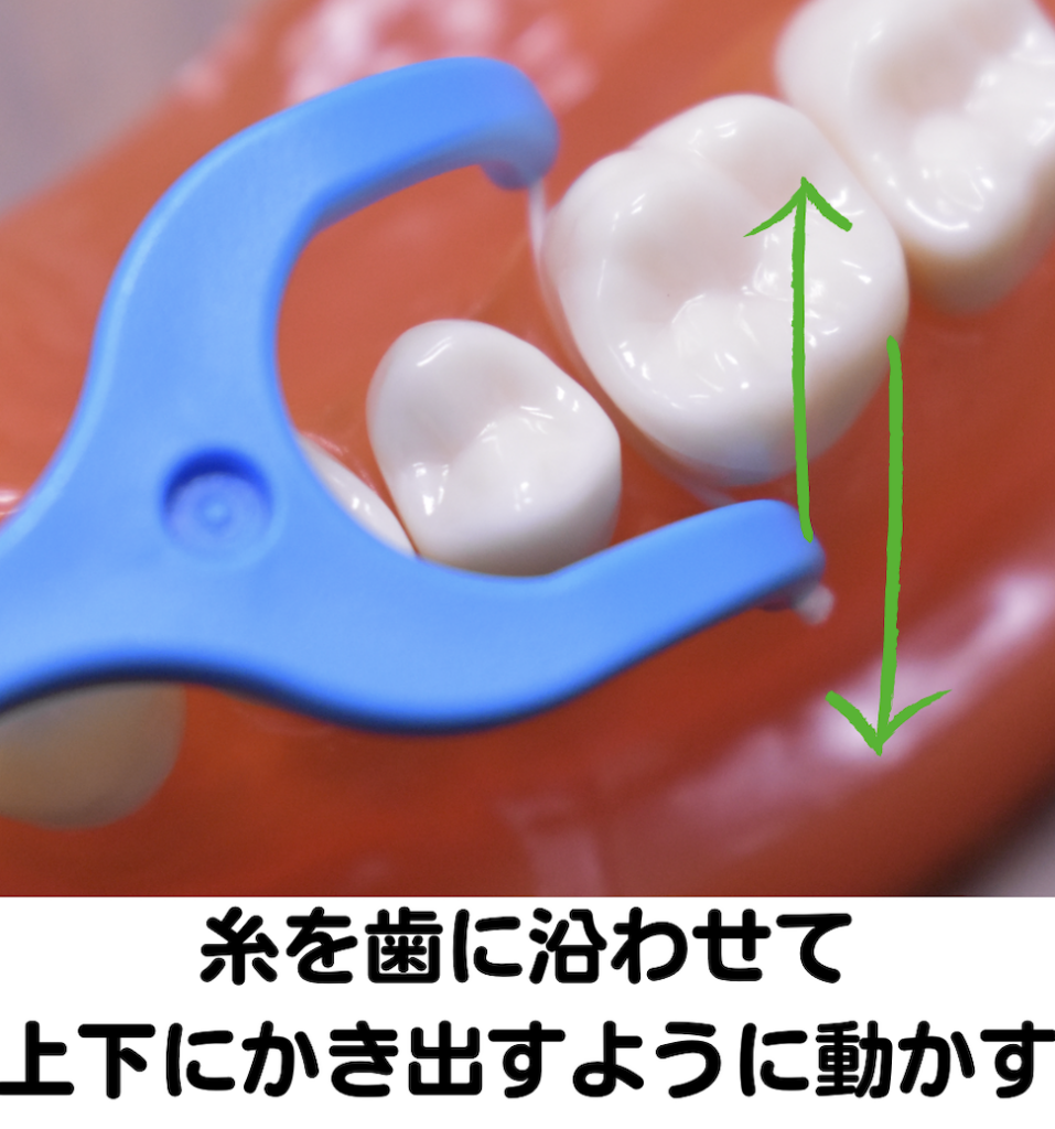 歯科医院　フロス　予防